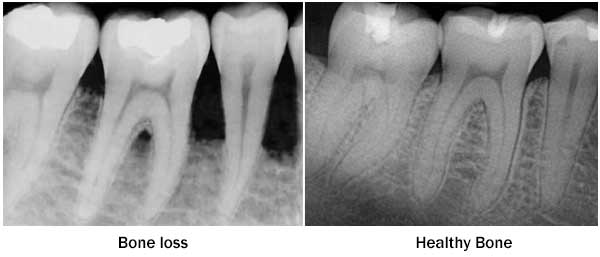 Bone Loss