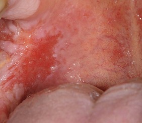 Erythroplakia