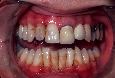 Gum Disease