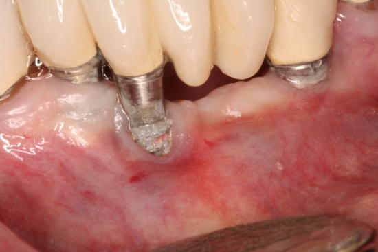 Implant Failure