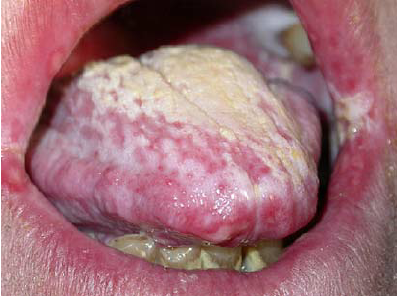 Oral Candidiasis