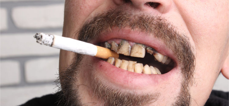 Tooth Staining